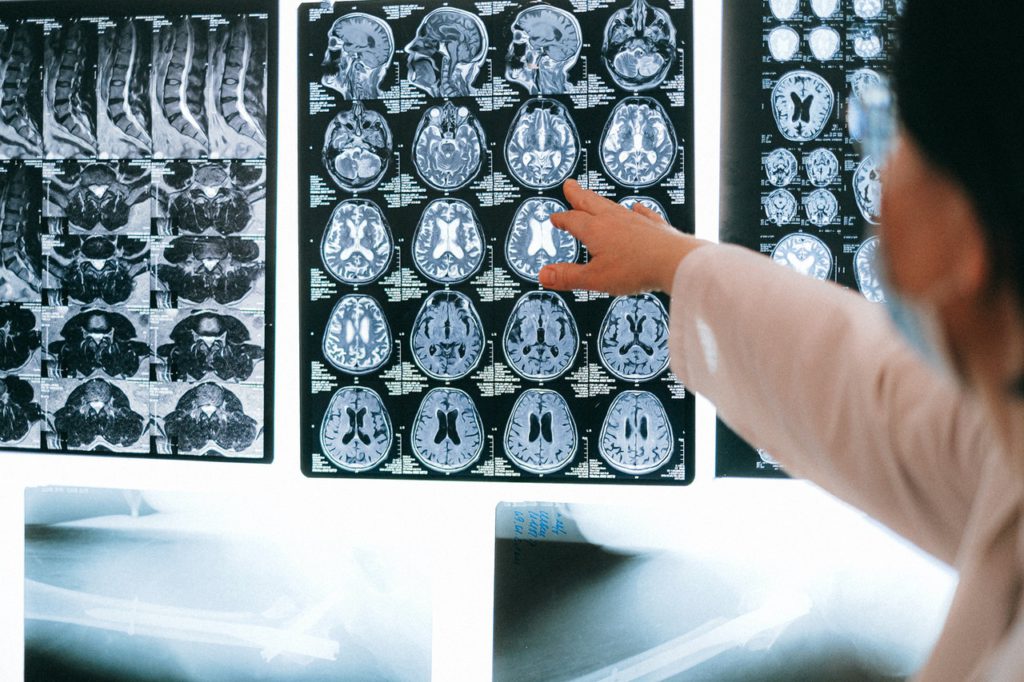 Tomografia de cerebro com uso de canabidiol